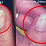 Symptoms and Diagnosis of Keratin Granulation